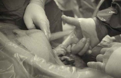 la bambina stringe il pollice del medico